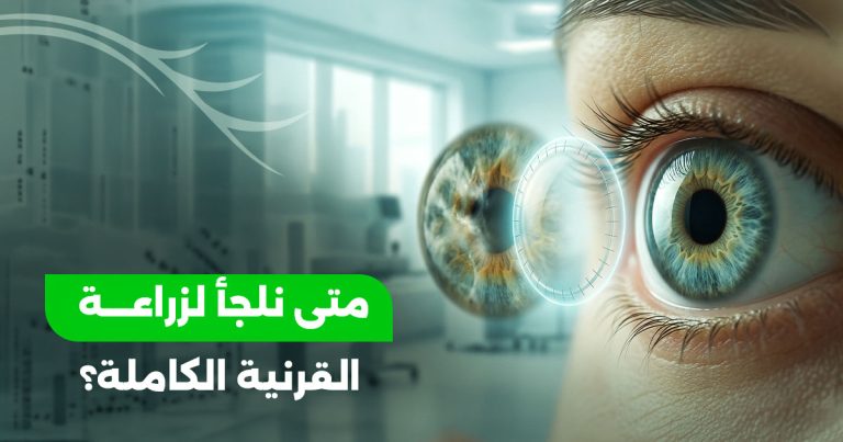 متى نلجأ لزراعة القرنية الكاملة؟ تعرف على نسب النجاح 2026
